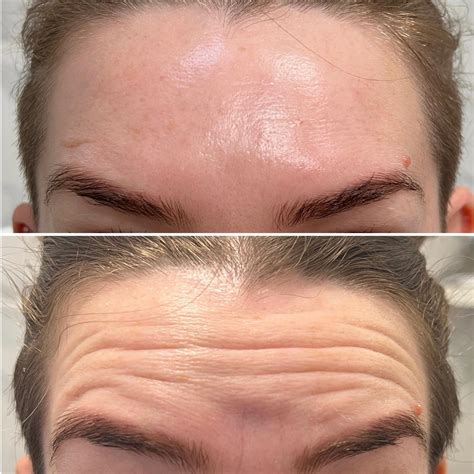 Before and after photos showcasing results of BOTOX® Cosmetic and dermal fillers