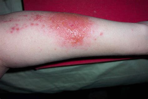 Illustration showing the characteristic red, bumpy, and blistered rash caused by urushiol oil.