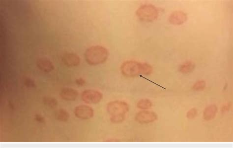 A close-up image showing a ring-shaped rash with raised, scaly borders on the back of a hand, indicative of tinea manuum.
