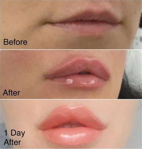 An illustration showing the anatomy of the lips, highlighting areas for filler injection, and before/after photos of lip augmentation.