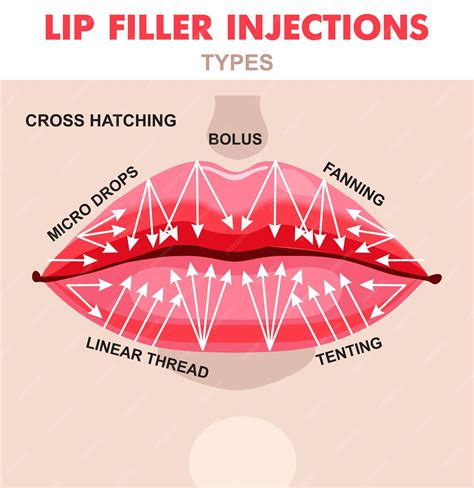 A medical illustration showing the injection points for lip fillers.