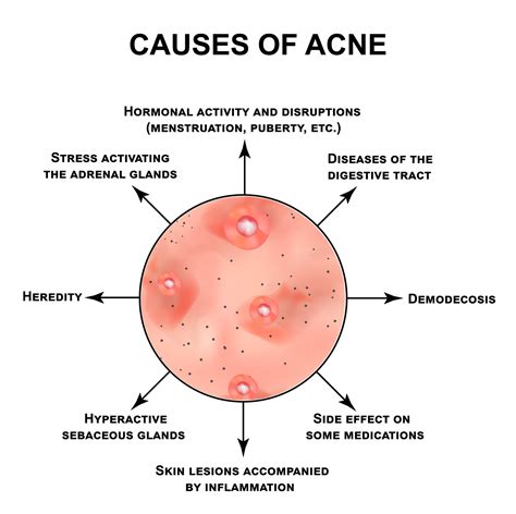 Infographic illustrating the causes of body acne: clogged pores, bacteria, inflammation, and hormonal influences.