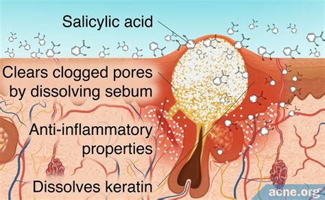 Diagram showing how salicylic acid penetrates pores to dissolve sebum and dead skin cells.