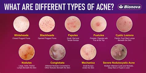 Collage of different types of acne body wash bottles, categorized by their primary benefits.