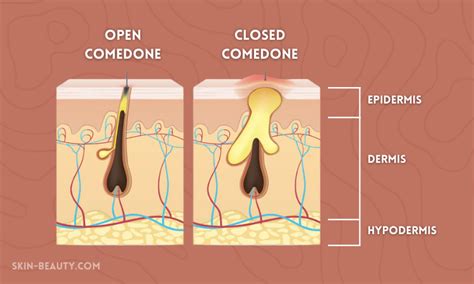 Illustration showing the difference between open and closed comedones.