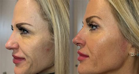 Before and after photos showcasing improvements in skin texture, wrinkles, and firmness after Morpheus8 treatment.