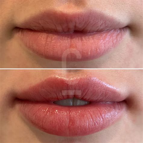 Before and after photos of a patient's lips treated with the Russian Lip Technique, showcasing increased height, defined cupid's bow, and natural volume.