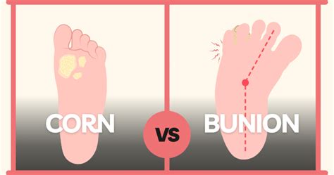 illustration showing the difference between a corn on a toe and a bunion at the base of the big toe