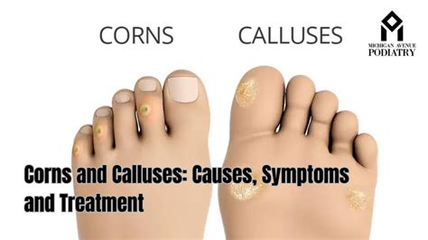 infographic comparing causes, symptoms, and treatments of corns and bunions