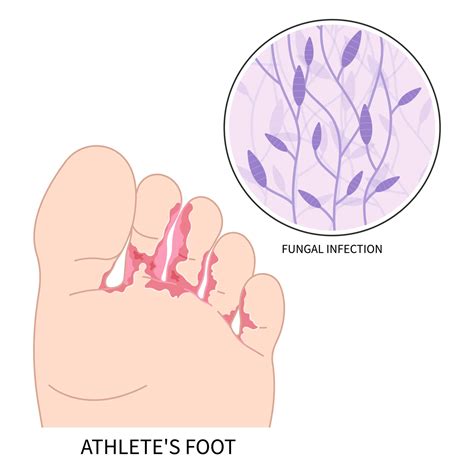 Illustration of common fungal skin infections like athlete's foot, ringworm, and jock itch