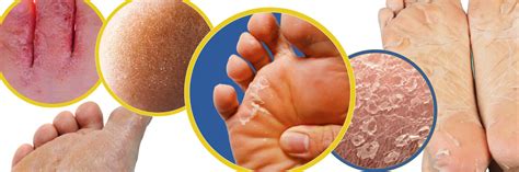 Infographic highlighting individuals who should avoid foot peeling masks (e.g., diabetics, those with eczema).