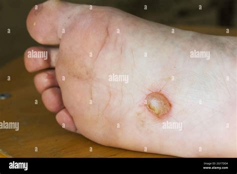 Close-up image of small, deep blisters on the sole of a foot, characteristic of dyshidrotic eczema.