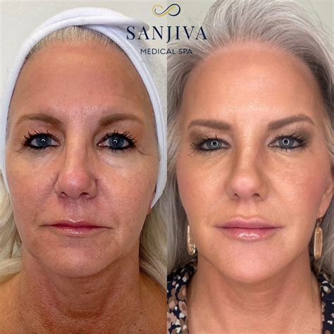 Before and after images showcasing results from BOTOX® and dermal filler treatments.
