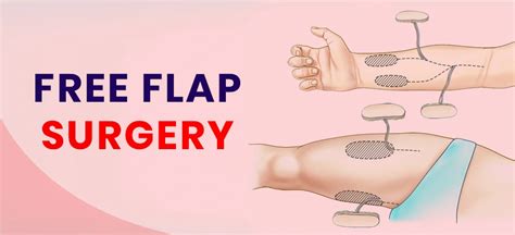 Diagram illustrating the process of flap surgery, showing tissue transfer with intact blood supply.