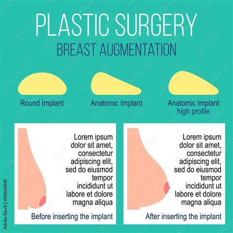 Before and after images of breast augmentation surgery.