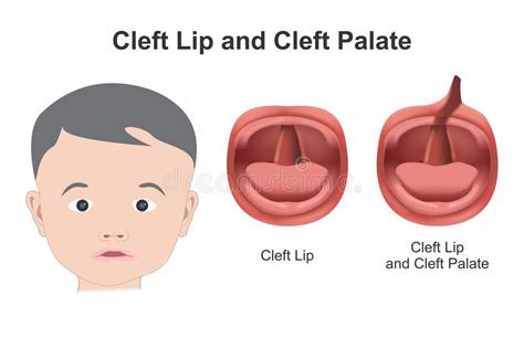 Illustration of a cleft lip and palate, showing the anatomical defect.