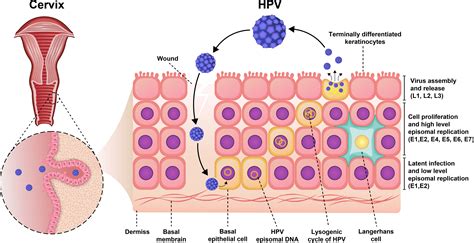 Diagram illustrating the HPV virus infecting skin cells to cause wart formation