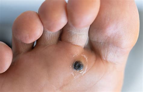 Close-up image of a plantar wart showing the characteristic black dots (clotted blood vessels)