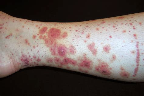 Illustration showing the characteristic rash of Henoch-Schonlein purpura on the legs and feet.