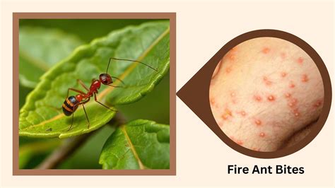 Diagram showing the progression of a fire ant sting: initial red welt, then blister, then pustule.