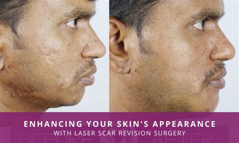 Before and after images (illustrative) showing the potential reduction in scar appearance with rosehip oil treatment.