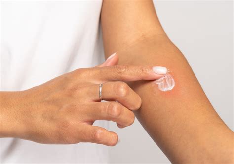 Illustration of a patch test being performed on the inner arm.