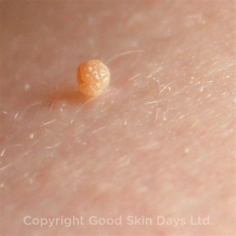Image of a typical skin tag, showing its flesh-colored appearance and small stalk.
