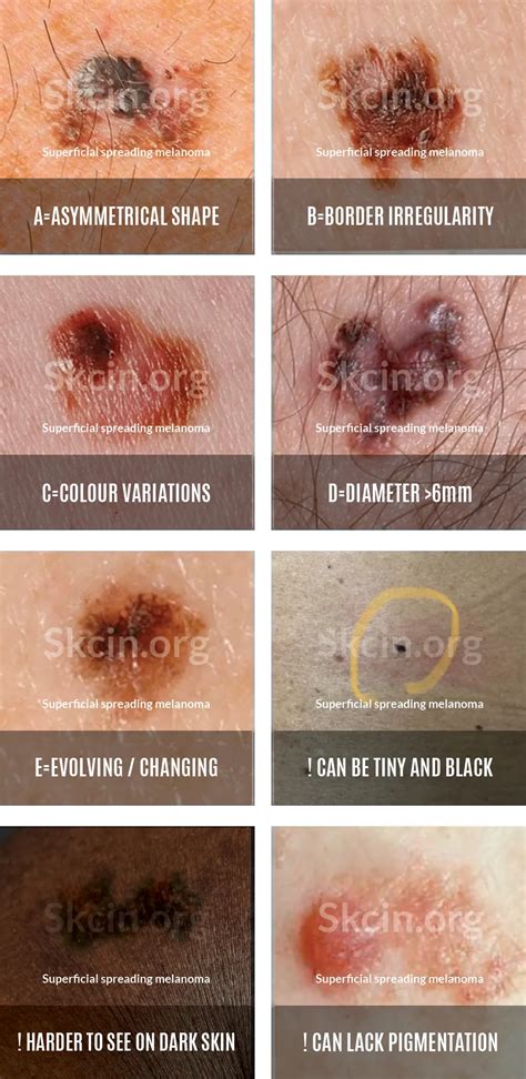 Side-by-side comparison images: a skin tag and a potentially cancerous mole, highlighting differences in shape and color.