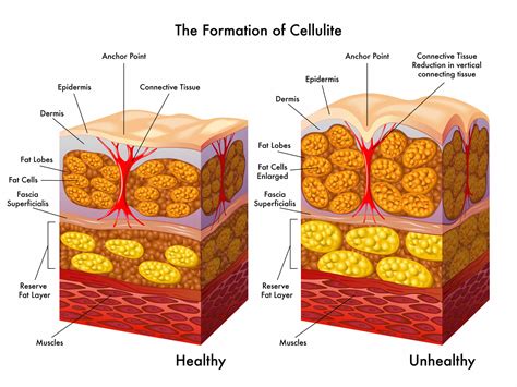 Infographic illustrating the causes of cellulite: subdermal fat, tissue thickening, and thinning skin.