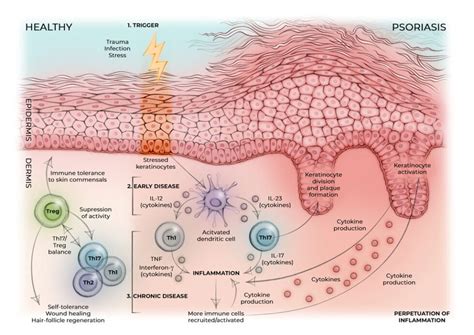 Infographic illustrating the mechanism of plaque psoriasis, showing immune cells attacking healthy skin cells and leading to inflammation and plaque formation.
