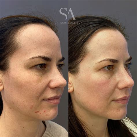 Before and after images of CO2 laser resurfacing treatment showing reduction in wrinkles and acne scars.