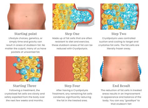Diagram illustrating the cryolipolysis process of CoolSculpting.