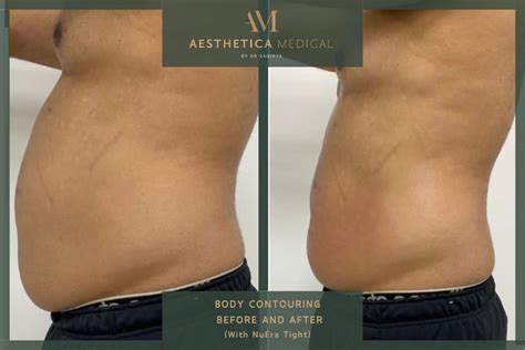 Before and after images showcasing body contouring results.
