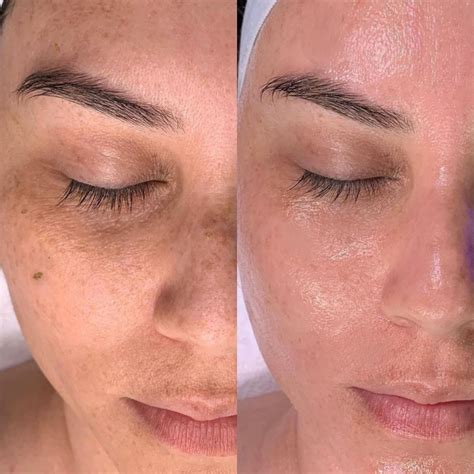 Split image showing before and after results of a Hydrafacial treatment, highlighting improved skin texture and radiance.