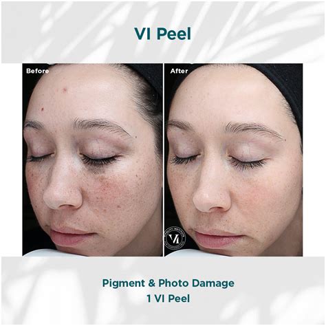 Before and after images of VI Peel treatment