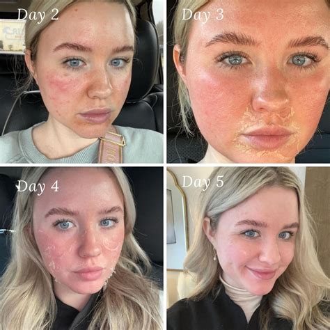 close-up of a person's face showing smooth, rejuvenated skin after a chemical peel treatment