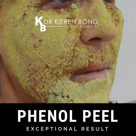 diagram illustrating different zones of the face that can be treated with phenol peels (e.g., perioral, lower face, full face)