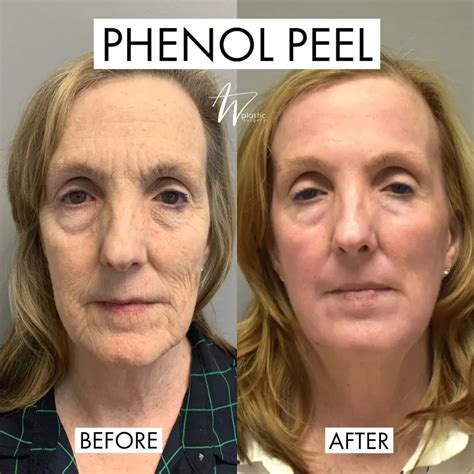 split image showing before and after photos of a lower eyelid phenol peel, highlighting reduced wrinkles and improved skin tone