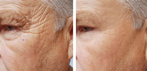 Before and after images showcasing improvements in skin texture and wrinkle reduction after retinol treatment.