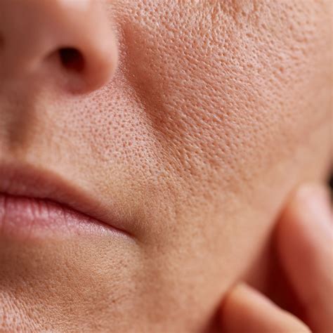 A close-up of facial skin showing visible pores.