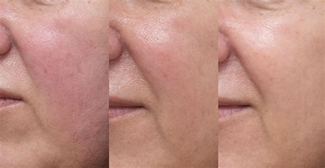 Close-up image of a skin treatment area showing mild redness after a laser procedure.