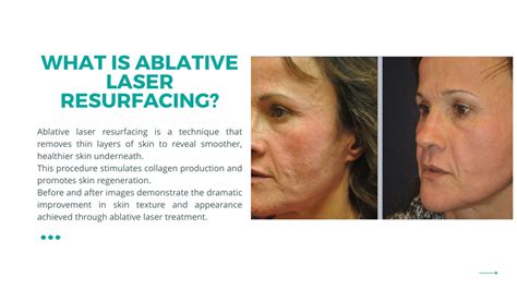 Infographic comparing different types of laser resurfacing (e.g., ablative vs. non-ablative, CO2 vs. fractional).