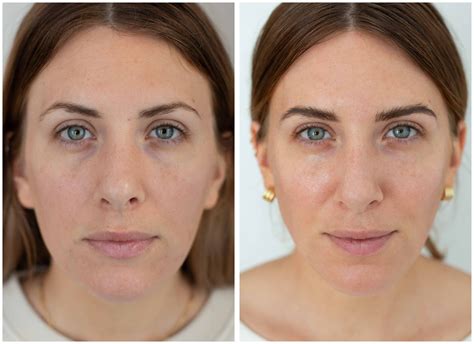 Before and after image showing wrinkle reduction from RoC eye cream