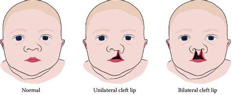 Diagram comparing unilateral and bilateral lip swelling, illustrating potential causes for each.