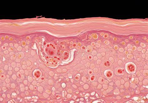 Microscopic view of a skin biopsy sample showing inflammation.