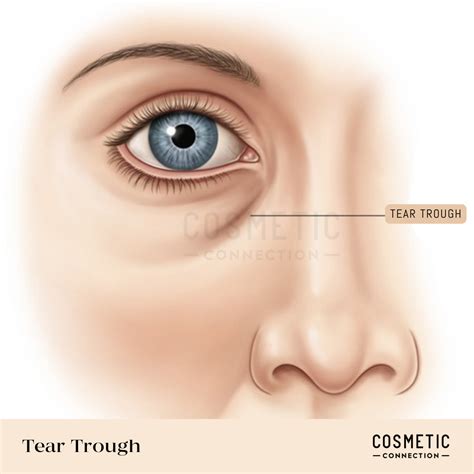 Infographic illustrating the anatomy of the under-eye area, highlighting the tear trough and potential causes of dark circles.