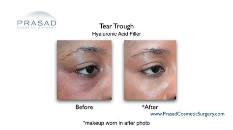 Diagram showing the injection of hyaluronic acid filler into the tear trough to restore volume and reduce shadowing.
