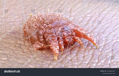 Illustration of Sarcoptes scabiei mite and typical scabies lesions on human skin.