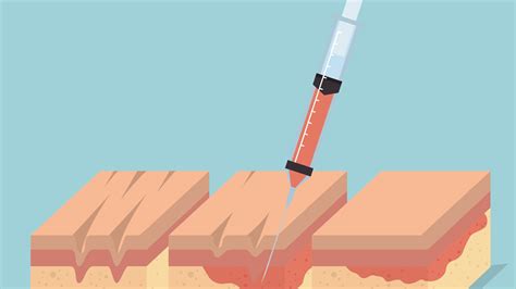 Illustration showing the timeline of Dysport's effectiveness, from injection to full effect and gradual wear-off.