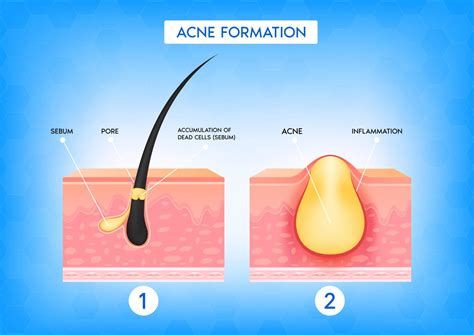 Illustration of skin pore with bacteria and sebum